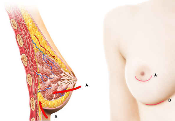 Diagram showing the two main incisions used for breast implant placement: lower hemi-areolar (A) and sub-mammary (B)